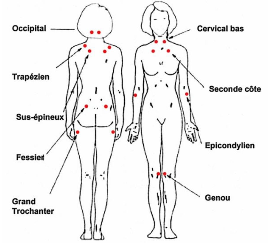 18 points de Yunus pour la recherche de la fibromyalgie 