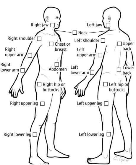 19 zones de douleurs de l'ACR pour le diagnostic de la fibromyalgie 